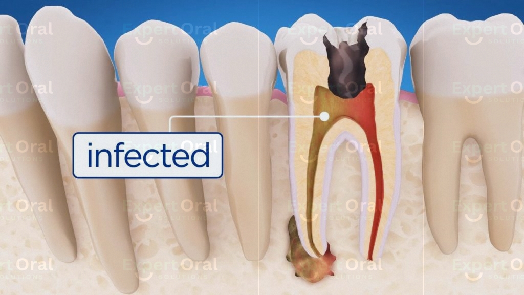 Can a Medicated Filling Save Your Tooth and Avoid a Root Canal?